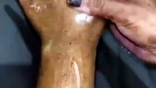 Skin hand foot remedy