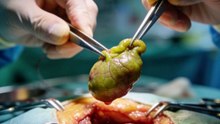 La vésicule biliaire joue un rôle essentiel dans la digestion des graisses. Fatigue, ballonnements, nausées ou douleurs après les repas peuvent révéler un déséquilibre.