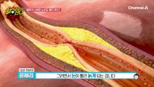 (공포) 고혈압 방치하면 눈 중풍까지!? 혈관이 나쁘면 노안도 빨리 온다!