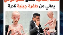 جعلت جسده بلا جلد يحميه.. حملة إنسانية لعلاج طفل عراقي يعاني من طفرة جينية نادرة