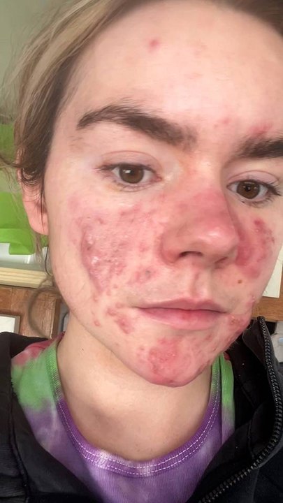 My acne doesn’t define me! ❤️