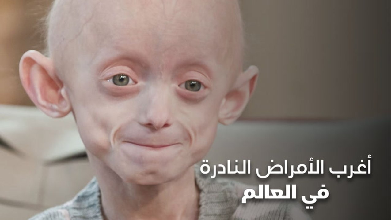 أغرب الأمراض النادرة في العالم