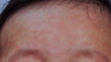Measles cases spread in West Midlands as vaccine advice is stepped up