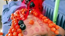 My pulley system failed against 100 cupping cups