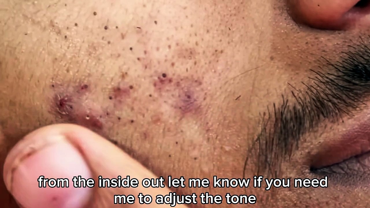 Sac be spa blackheads elderly men face | sac be spa men face blackhead 2026 | sac be spa facial