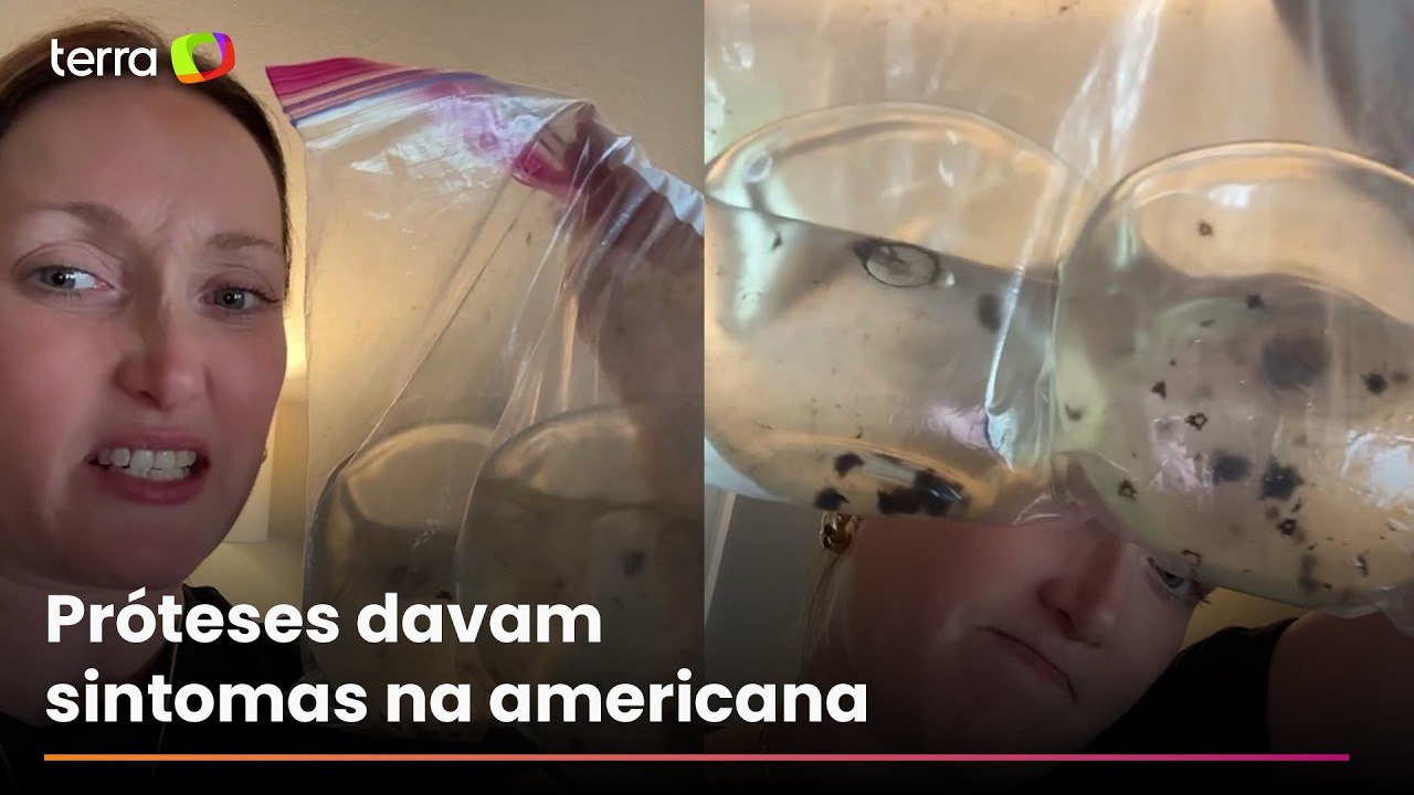 Mãe faz alerta após descobrir mofo em implantes mamários nos EUA: ‘Não vale a pena’