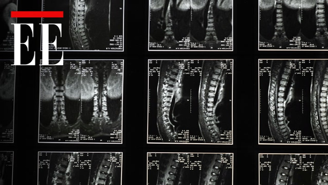 Osteoporosis: un problema silencioso que el sistema de salud no está detectando