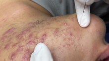 Blackheads Removal #3
