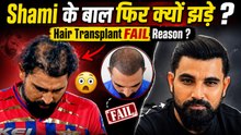 Mohammed Shami Hair Transplant FAIL? लाखों रुपये खर्च, फिर भी नहीं रुका Hair Fall ? Reason Explained