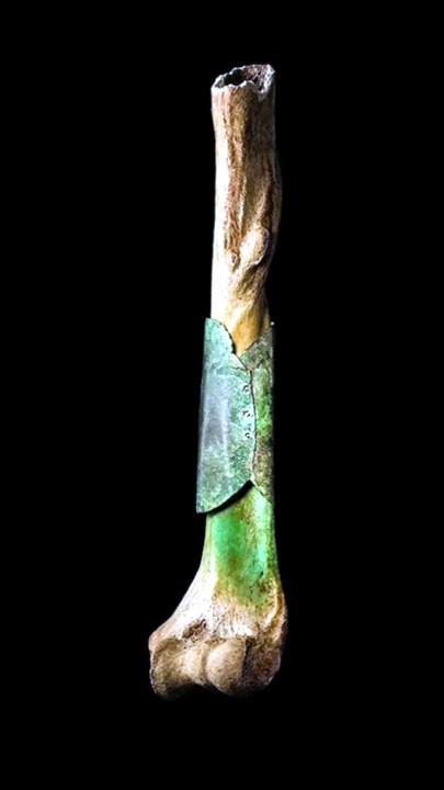 Why Did This Medieval Skeleton Have a Copper Pl...
