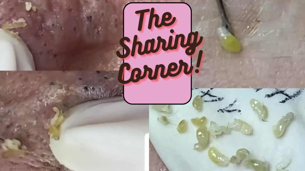 The Sharing Corner...PIMPLES!