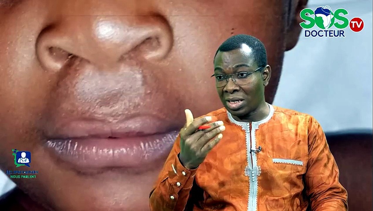 La prise en charge du bec de lièvre