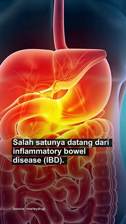 Gen Z Hati-hati, Pakar UI Ingatkan Gejala yang Bisa Berujung Kanker Usus Besar