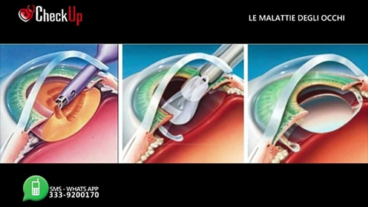 LE MALATTIE DEGLI OCCHI