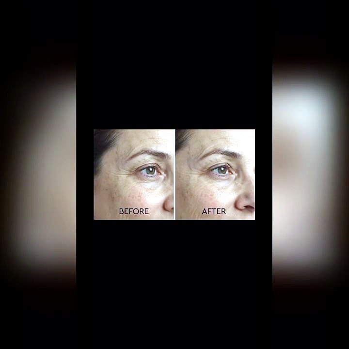 Fractional RF Skin Rejuvenation — Before & After Results | Velvet Skin London
