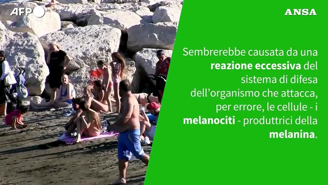 Ansa VERIFIED - Con la vitiligine si puo' prendere il sole?