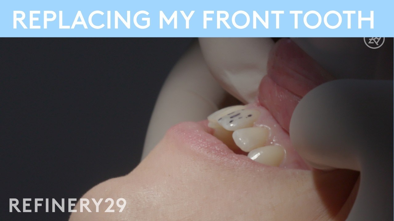 I Had to Replace My Front Tooth | Refinery29 | Macro Beauty
