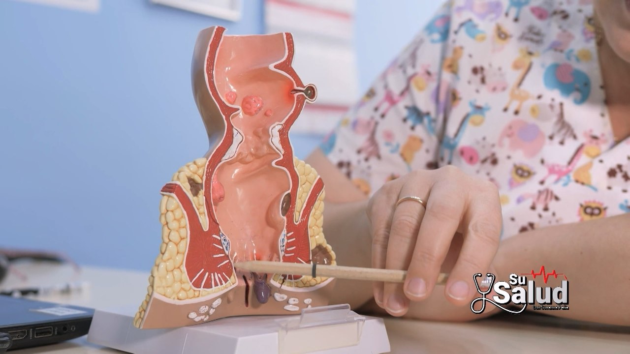 Su Salud: Causas y tratamientos de las hemorroides
