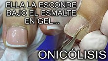 ¡La onicólisis no es una enfermedad! Descubre la verdad aquí