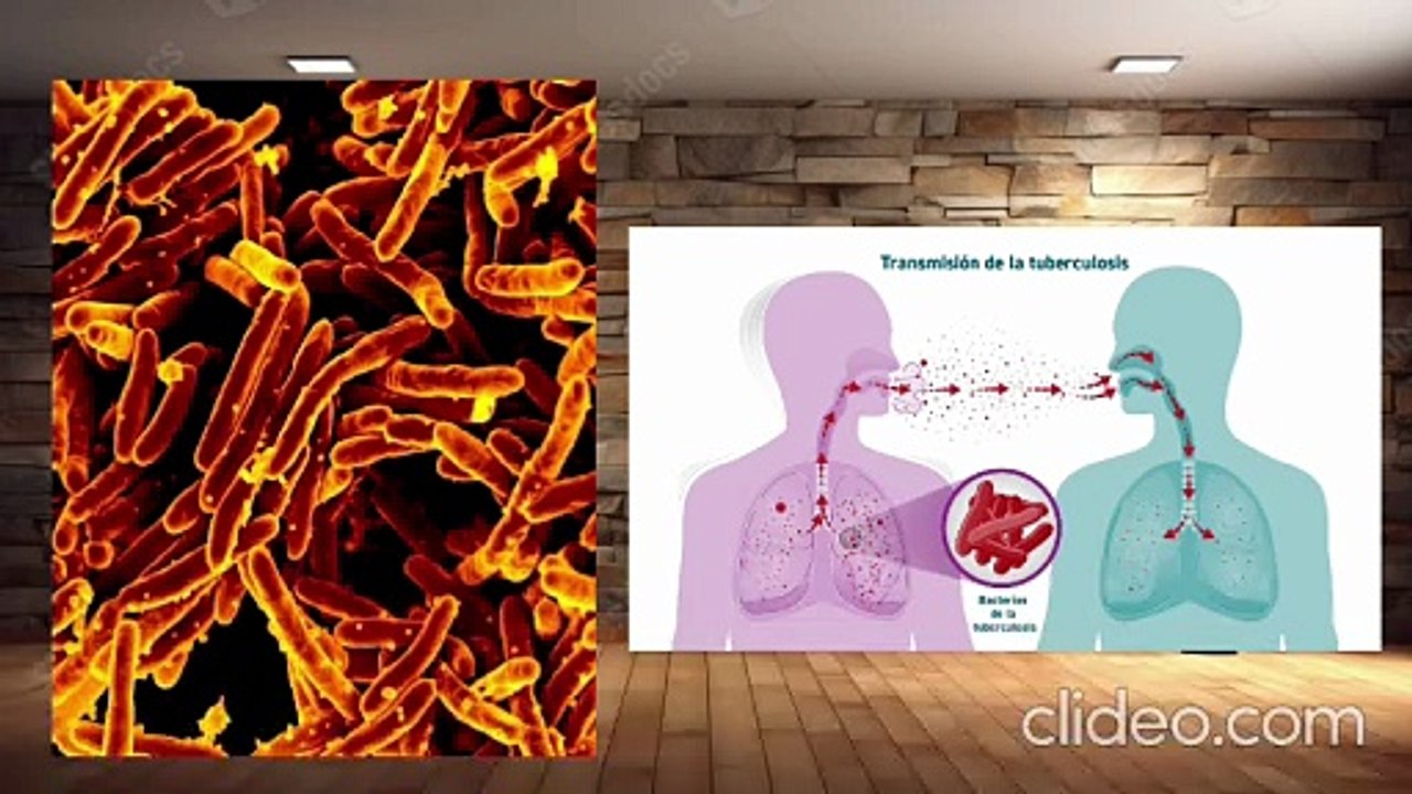 Tuberculosis