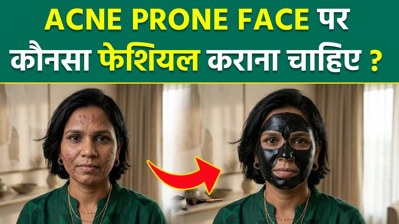 Facial for Acne Prone Skin: Pimple Ke Liye Kaun Sa Facial Karen | Best Skincare Routine