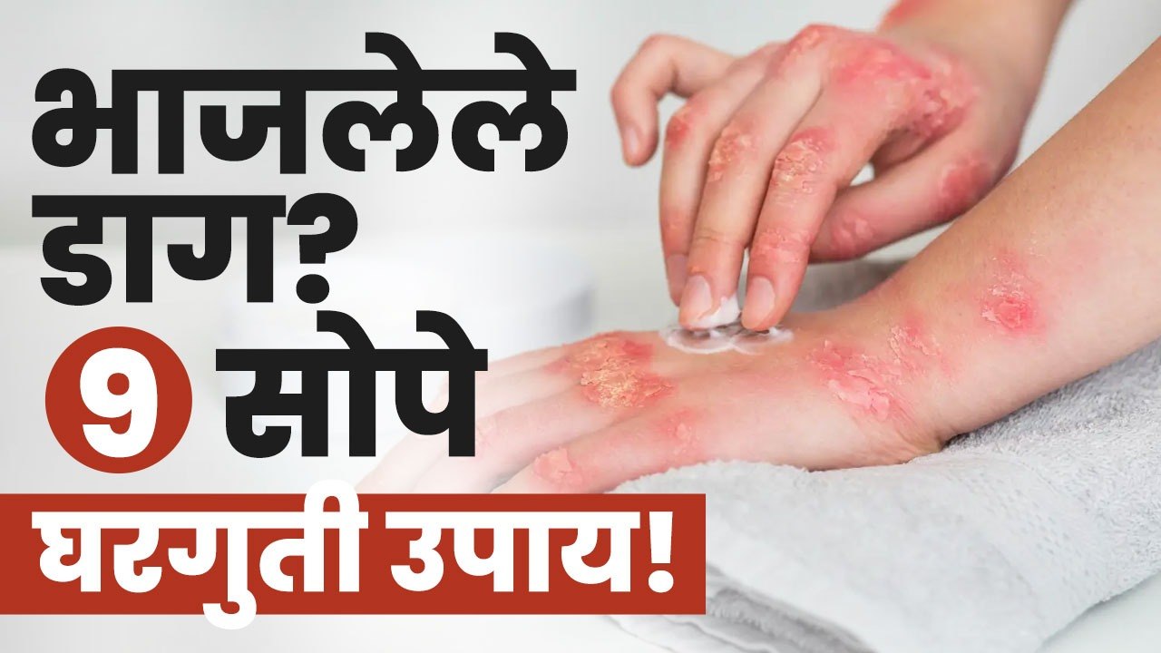 चटका लागला? करा हे उपाय! | Burn Relief | Home Remedies