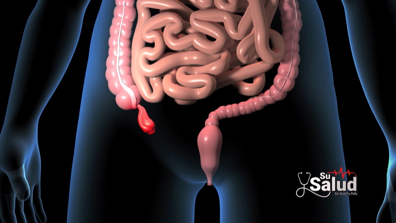 Su Salud: ¡Corra, la apendicitis es una emergencia!
