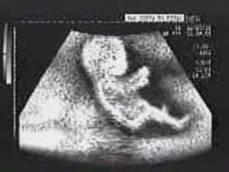 Echographie de gars