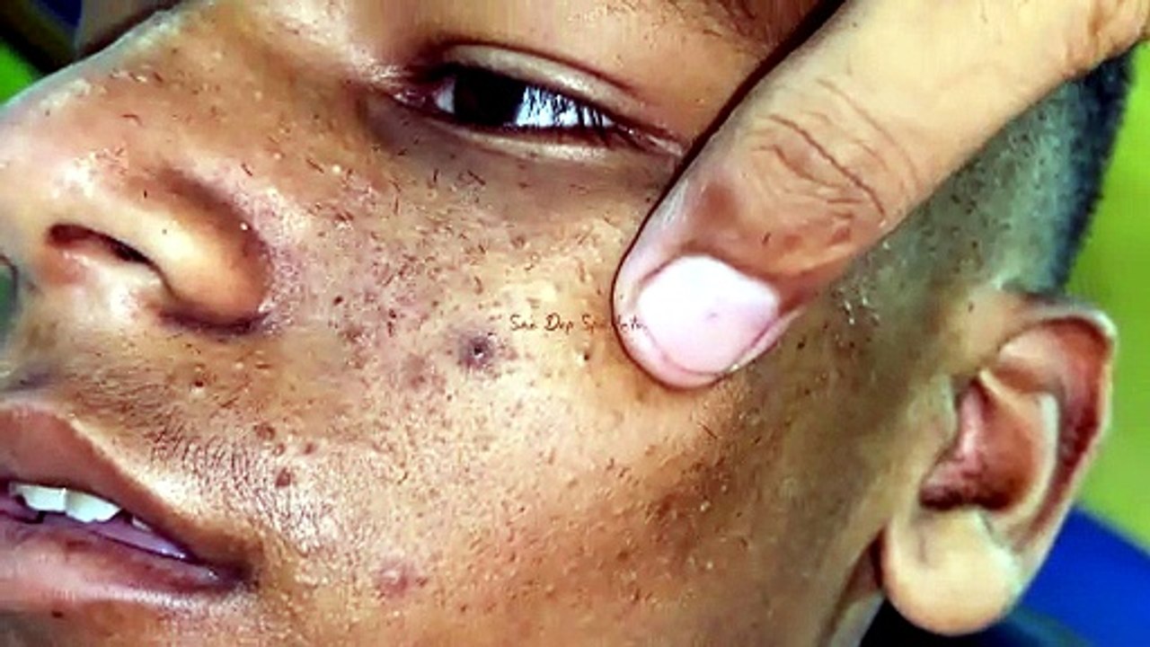 Sac dep spa Big Deep Blackheads Treatment asmr #400