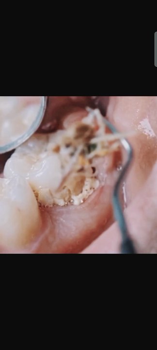 Amazing Deep Teeth Cleaning and Restoration Process