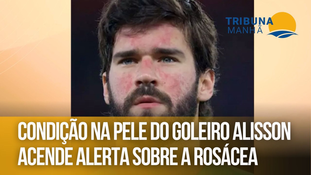 Condição na pele do goleiro Alisson acende alerta sobre a rosácea
