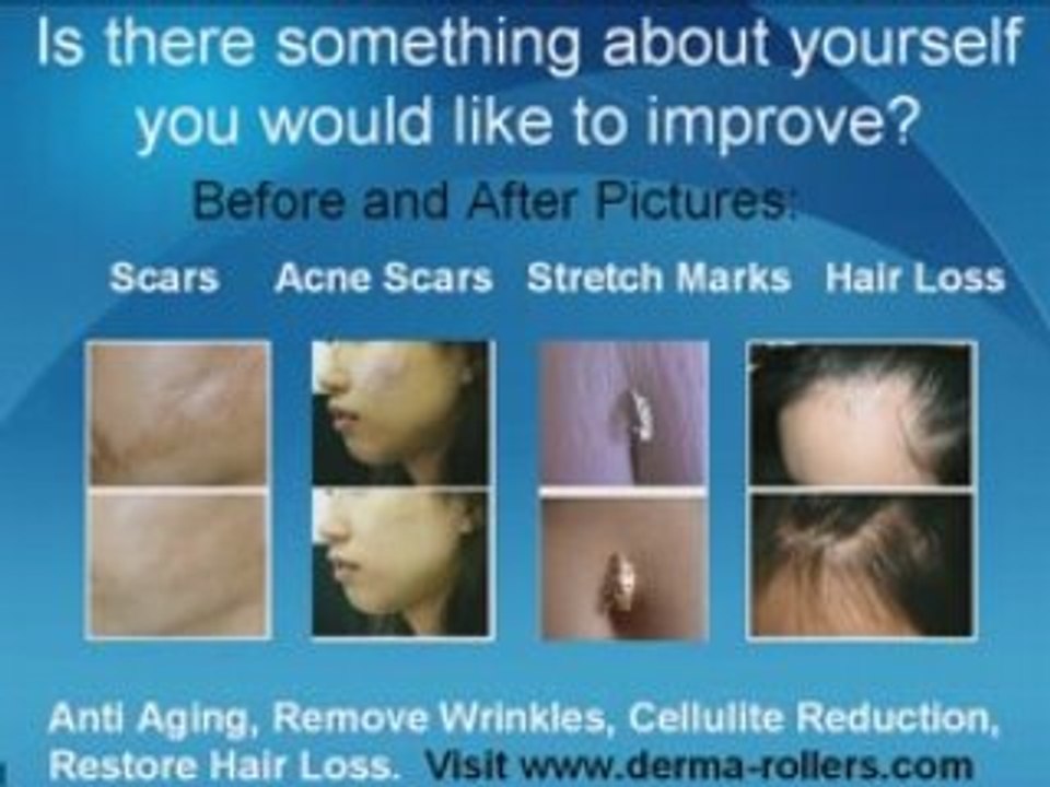 Remove wrinkles, stretch marks and scars with a Derma Roller