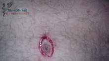 Σπίλος | Βιοψία Σπίλου Μηρού με Τοπική Αναισθησία