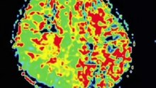Mri study
