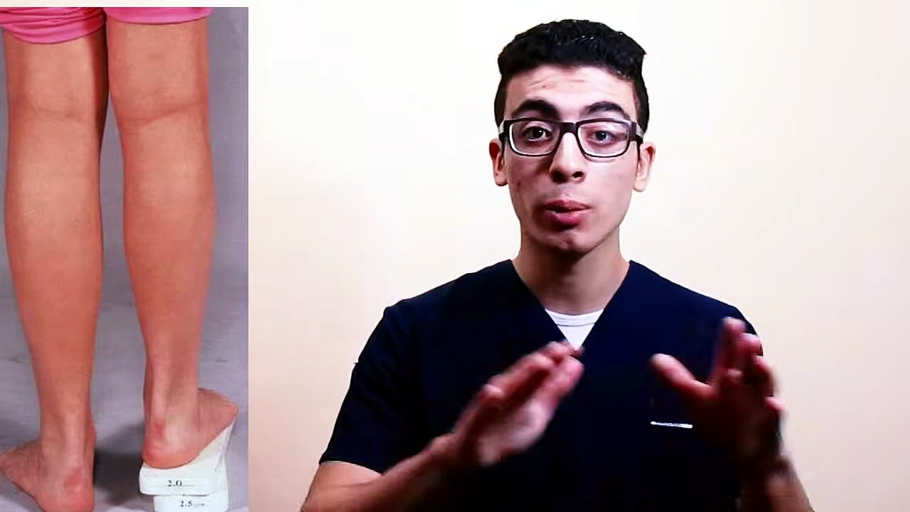 044 - تشخيص وعلاج الانحناء الجانبى للعمود الفقرى(الجنف)｜ scoliosis treatment