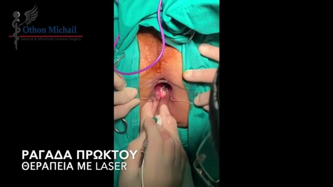 Ραγάδα Πρωκτού | Θεραπεία με Laser (Laser Fissuroplasty)