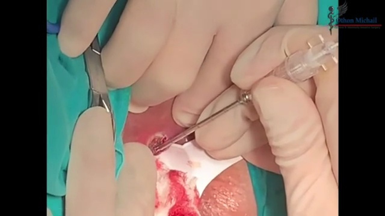 Ραγάδα Πρωκτού | Εξάχνωση Ραγάδας με Laser (Laser Fissuroplasty)