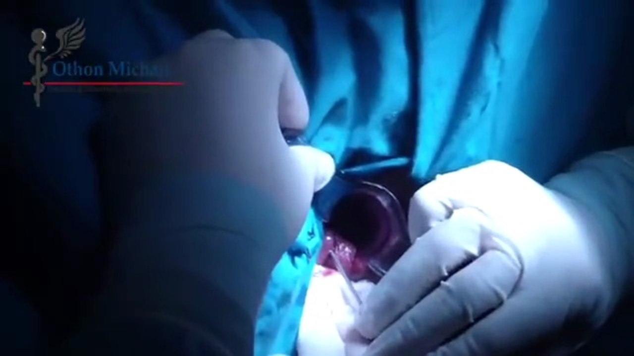 Αιμορροΐδες | Θεραπεία με Laser (Laser Hemorrhoidoplasty – LHP)