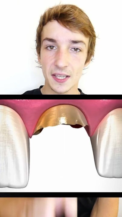 Perte de dent