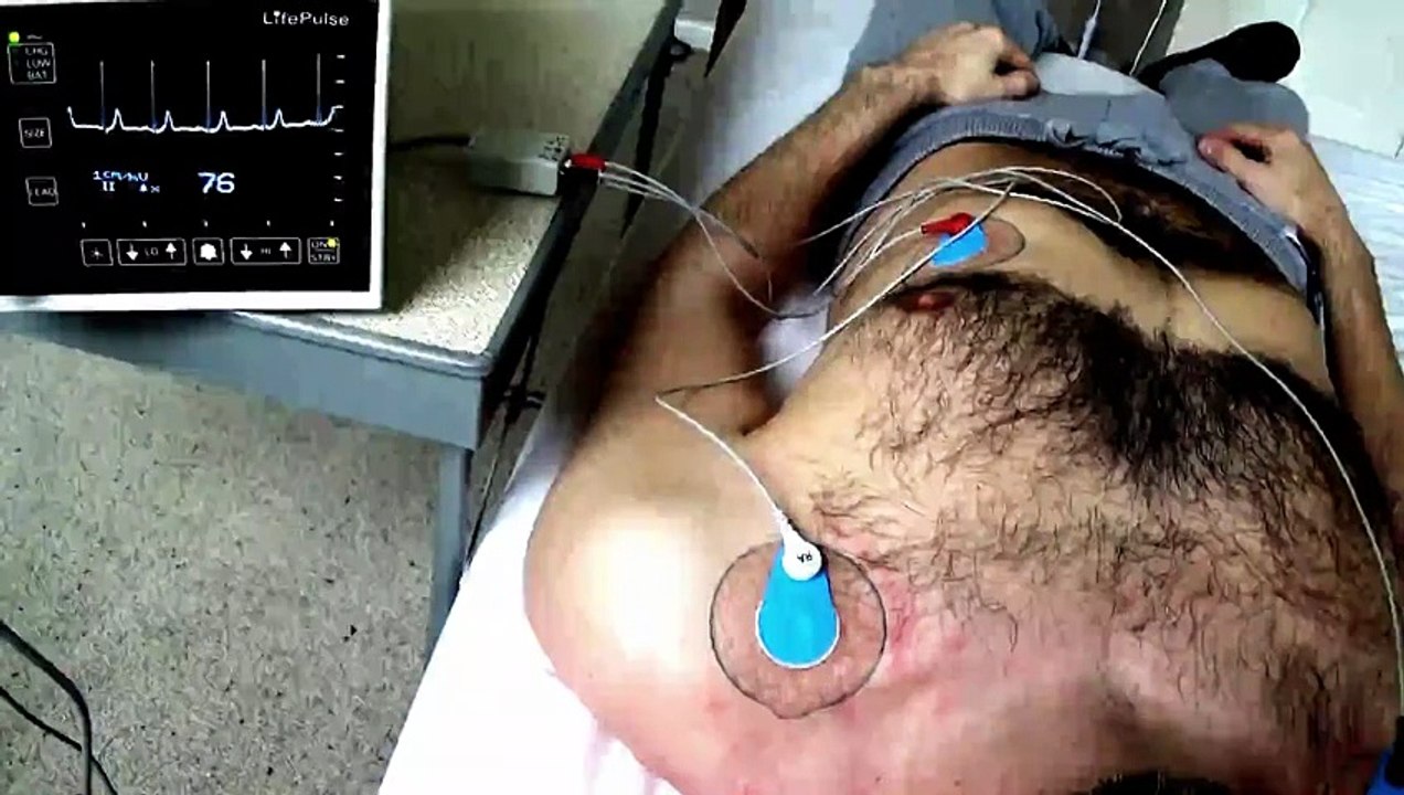 Male resting EKG with PVC