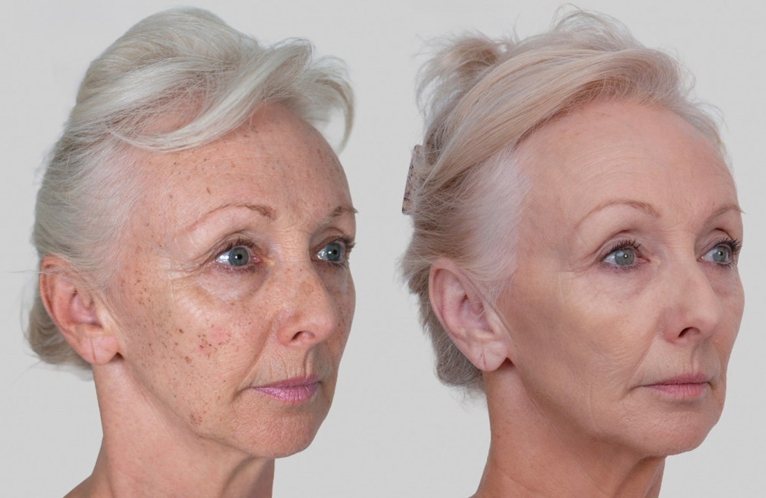 Debbie McGee feels decades younger after undergoing nonsurgical facelift