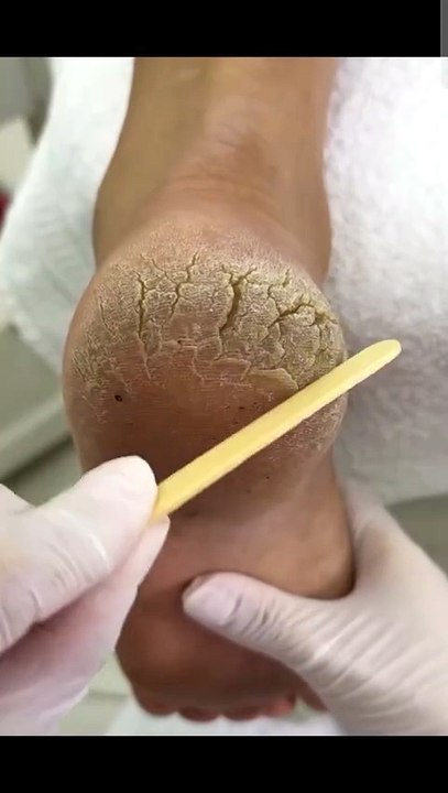 Deep Cracked Heel Restoration | Satisfying Foot Care Treatment & ASMR
