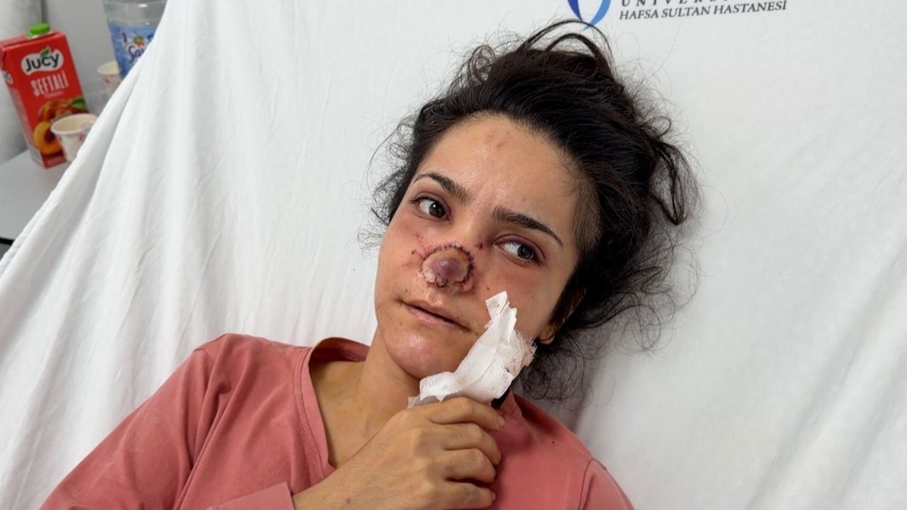 Eşi tarafından burnu ısırılıp koparılan kadın yaşadıklarını anlattı: Acıyla balkondan atlamayı bile düşündüm
