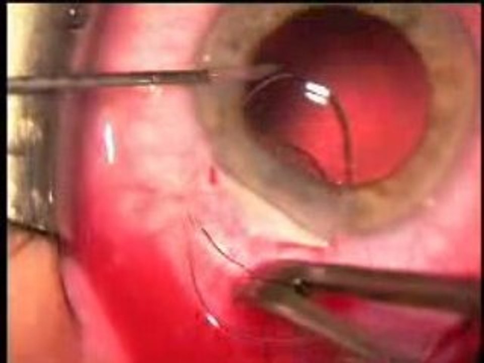 implants oculaires (pose)