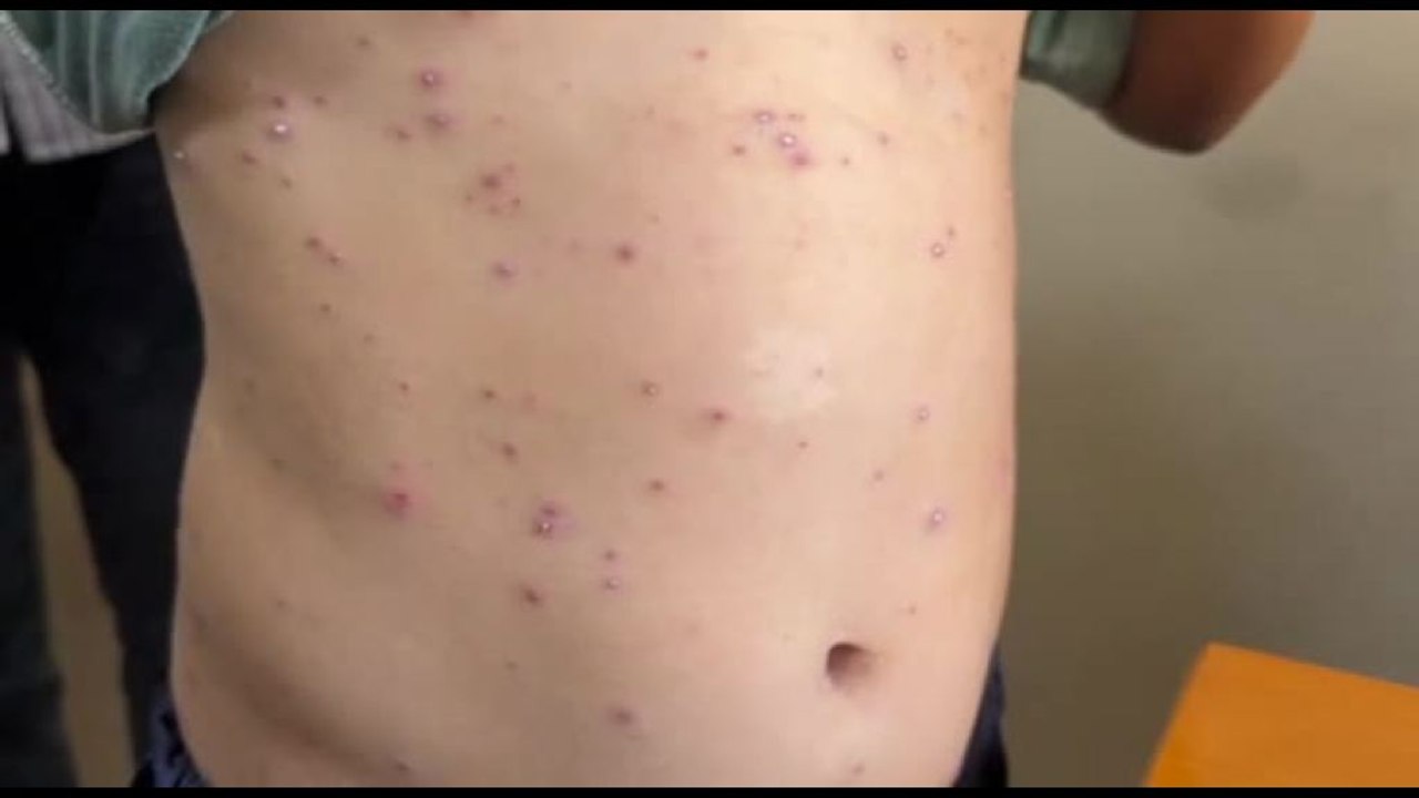 Epidemia di varicella a Gaza: "Impossibile isolarsi"
