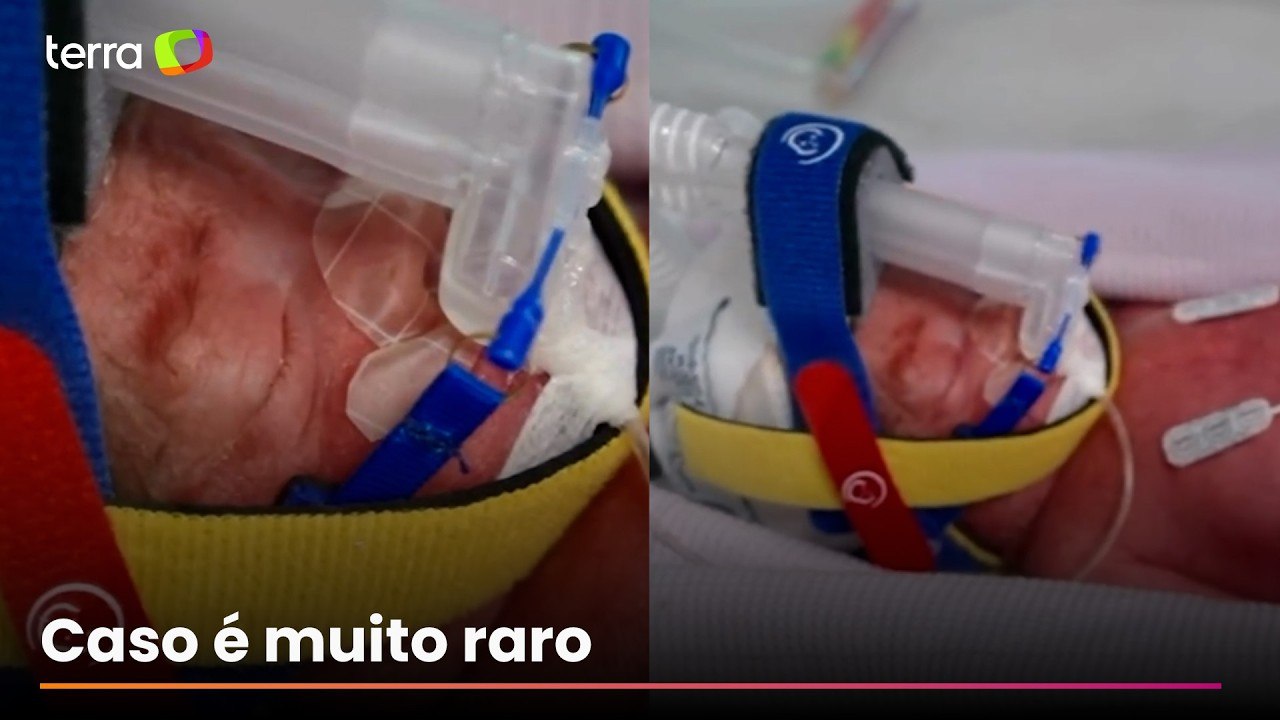 Quadrigêmeas idênticas nascem na Austrália em caso raríssimo: 'Uma em cada 15 milhões de gestações'