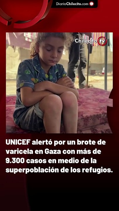 UNICEF alertó por un brote de varicela en Gaza con más de 9.300 casos en medio de la superpoblación de los refugios.