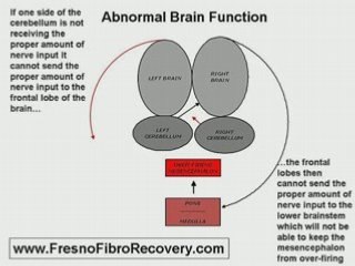 Fresno Fibromyagia Chronic Fatigue Treatment Symptoms