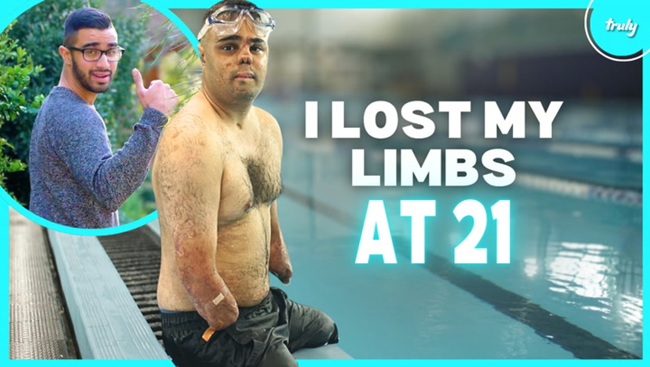 I Lost My Limbs & Nose - But Not My Love For Life | BORN DIFFERENT