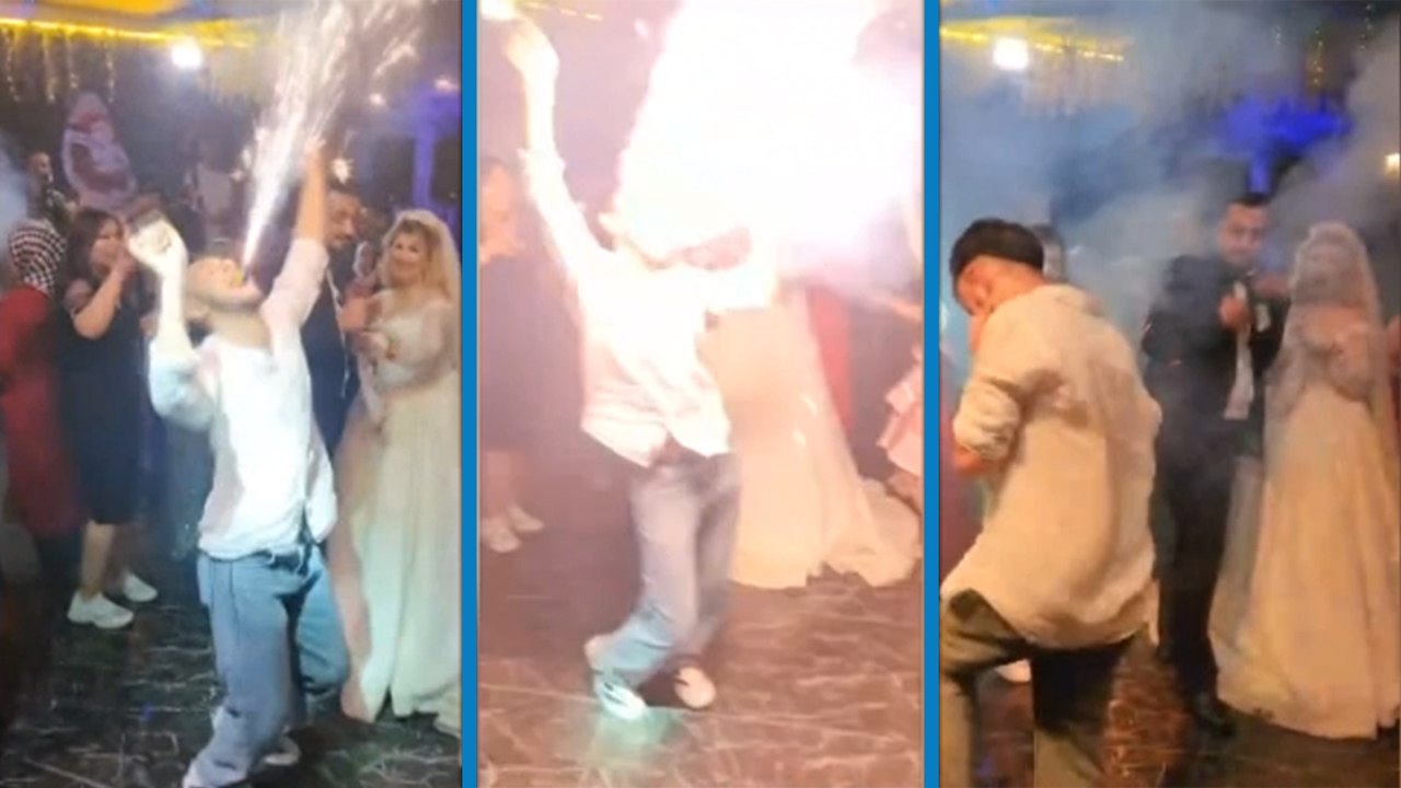 Düğünde yaktığı meşale yüzüne patladı